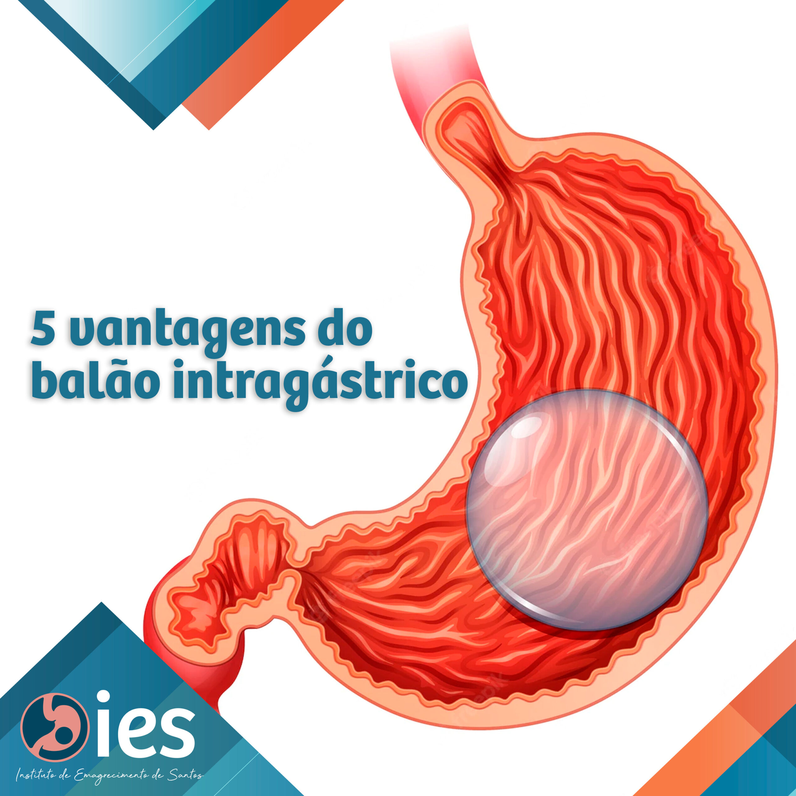 5 vantagens do balão intragástrico